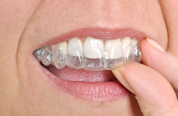 close-up-of-putting-in-clear-aligners-goleta-ca