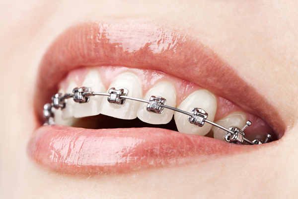 orthodontist-in-santa-barbara-ca